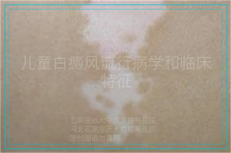 儿童白癜风流行病学和临床特征