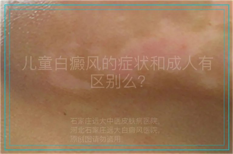 儿童白癜风的症状和成人有区别么？
