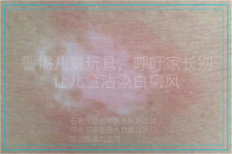 警惕儿童玩具，呼吁家长别让儿童沾染白癜风