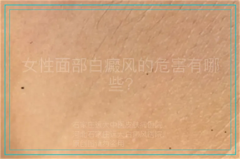 女性面部白癜风的危害有哪些?