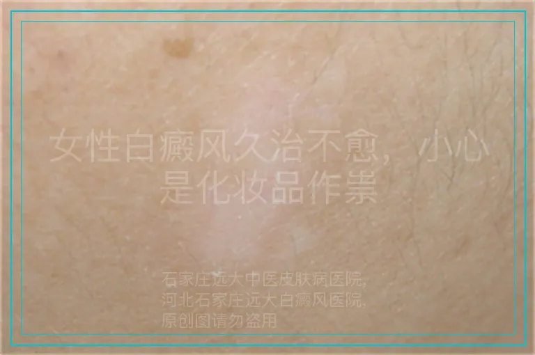 女性白癜风久治不愈，小心是化妆品作祟