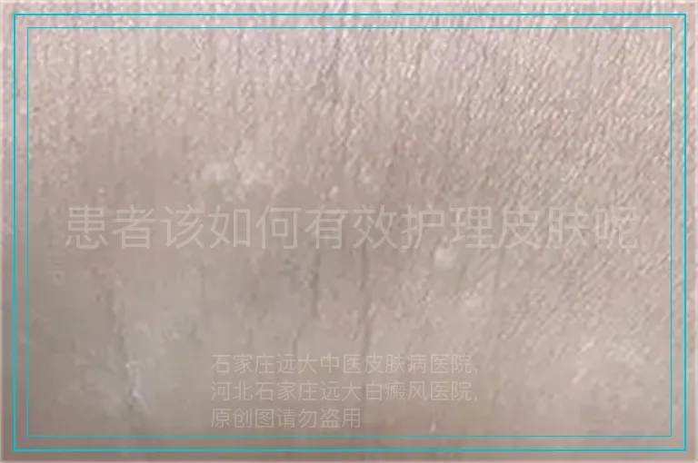 患者该如何有效护理皮肤呢