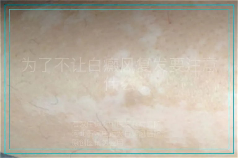 为了不让白癜风复发要注意什么
