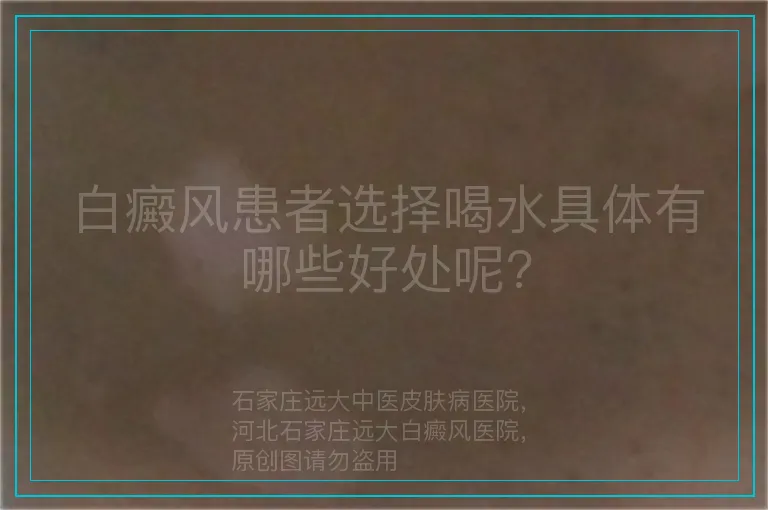 白癜风患者选择喝水具体有哪些好处呢?