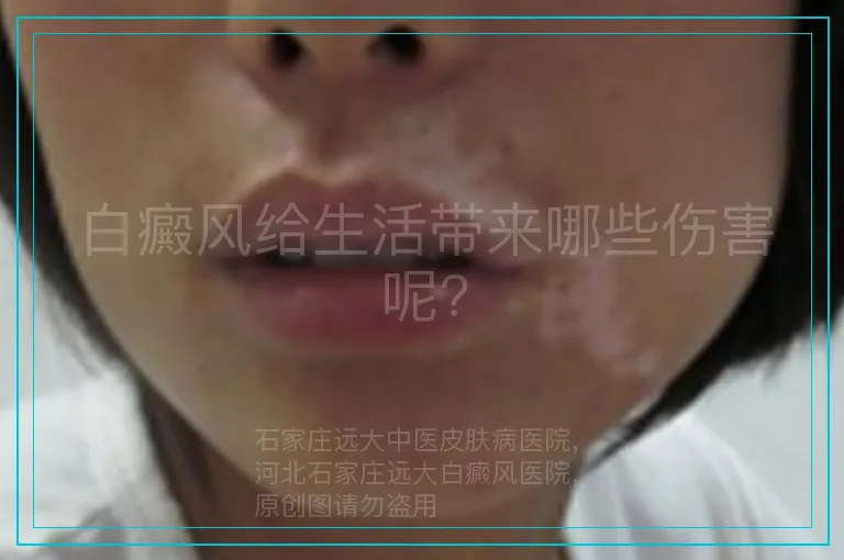 白癜风给生活带来哪些伤害呢?