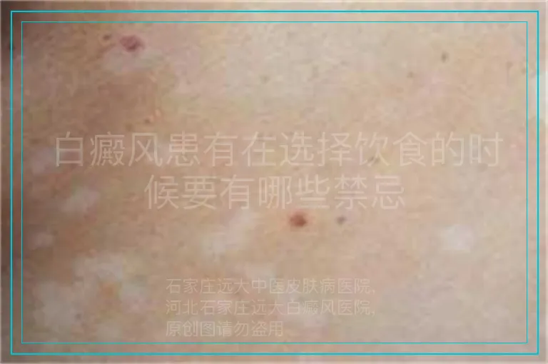 白癜风患有在选择饮食的时候要有哪些禁忌