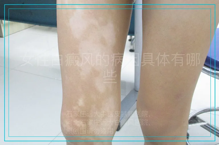 女性白癜风的病因具体有哪些