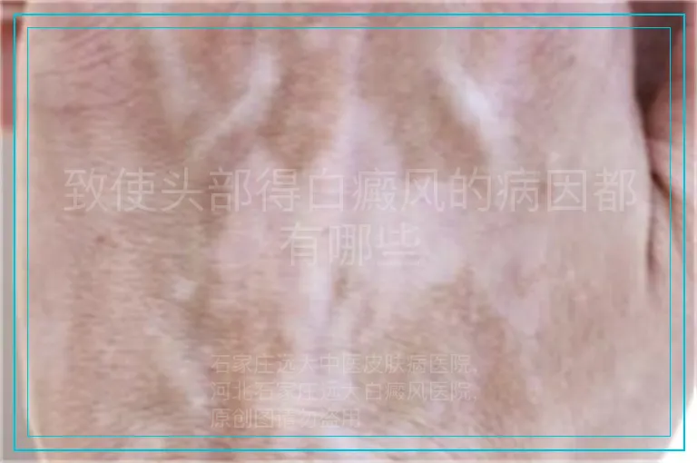 致使头部得白癜风的病因都有哪些