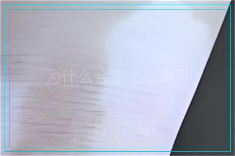 为什么会患上白癜风