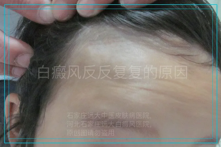 白癜风反反复复的原因