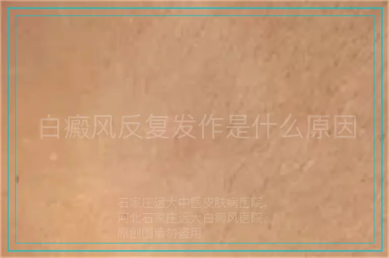 白癜风反复发作是什么原因