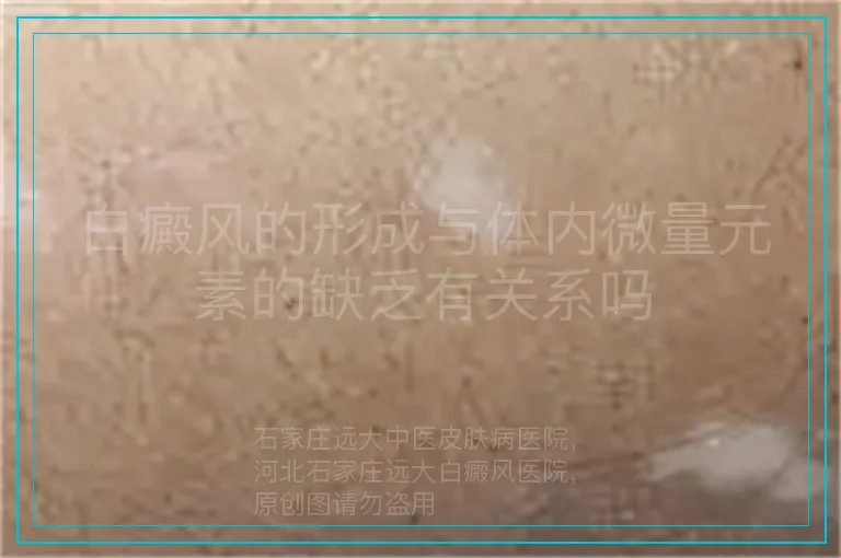 白癜风的形成与体内微量元素的缺乏有关系吗