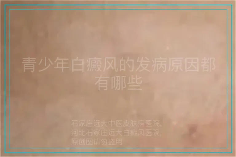 青少年白癜风的发病原因都有哪些