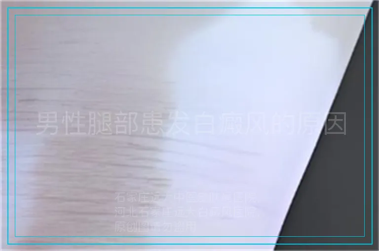 男性腿部患发白癜风的原因