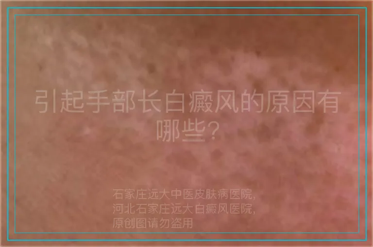 引起手部长白癜风的原因有哪些?