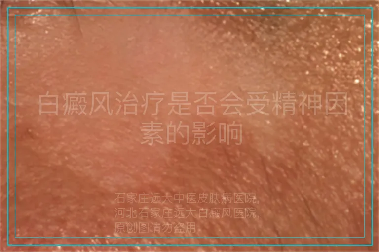 白癜风治疗是否会受精神因素的影响
