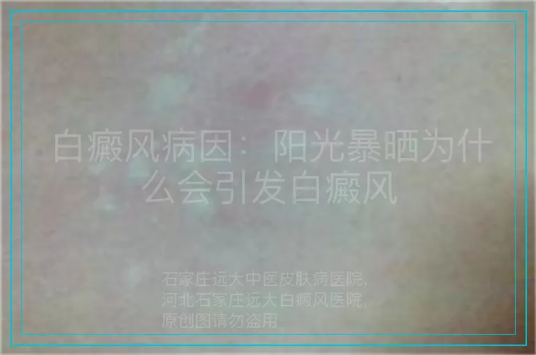 白癜风病因：阳光暴晒为什么会引发白癜风