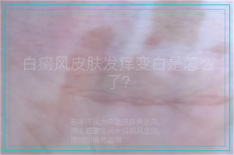 白癜风皮肤发痒变白是怎么了？