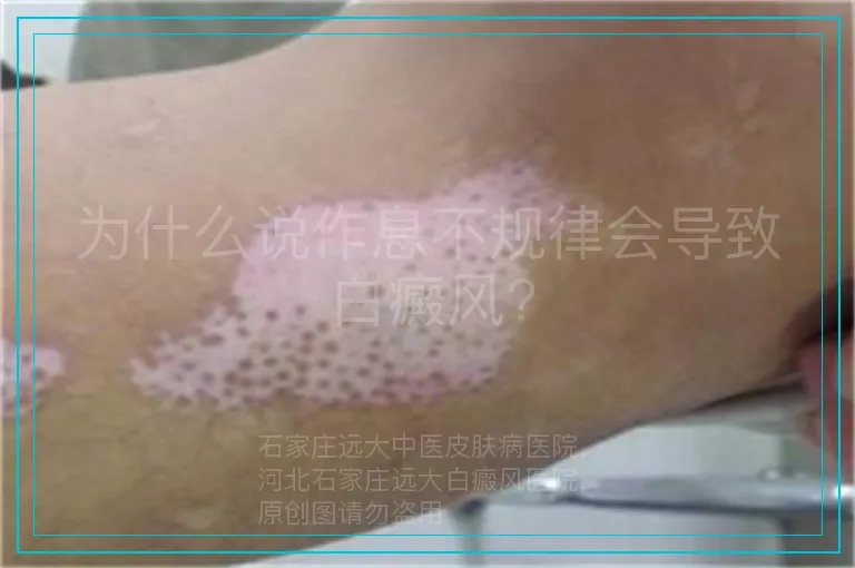 为什么说作息不规律会导致白癜风?
