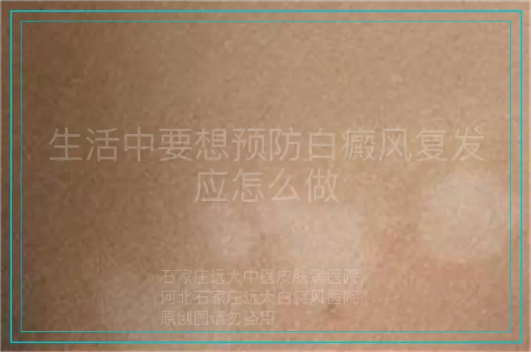 生活中要想预防白癜风复发应怎么做