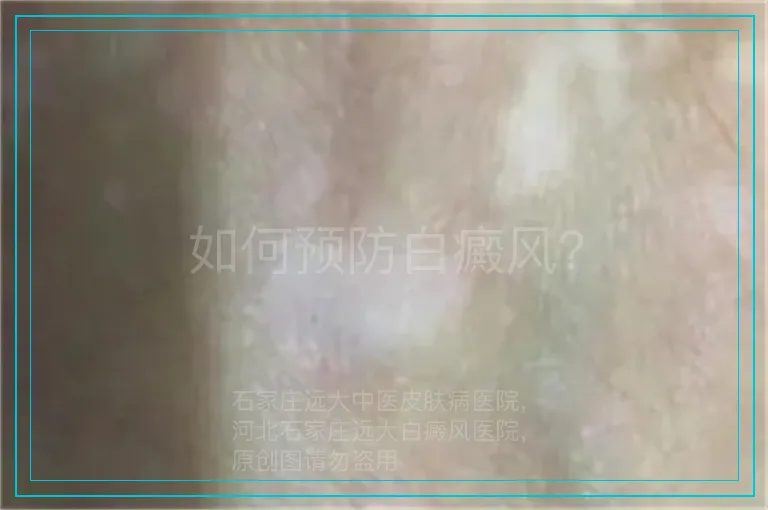 如何预防白癜风？