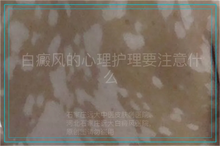白癜风的心理护理要注意什么