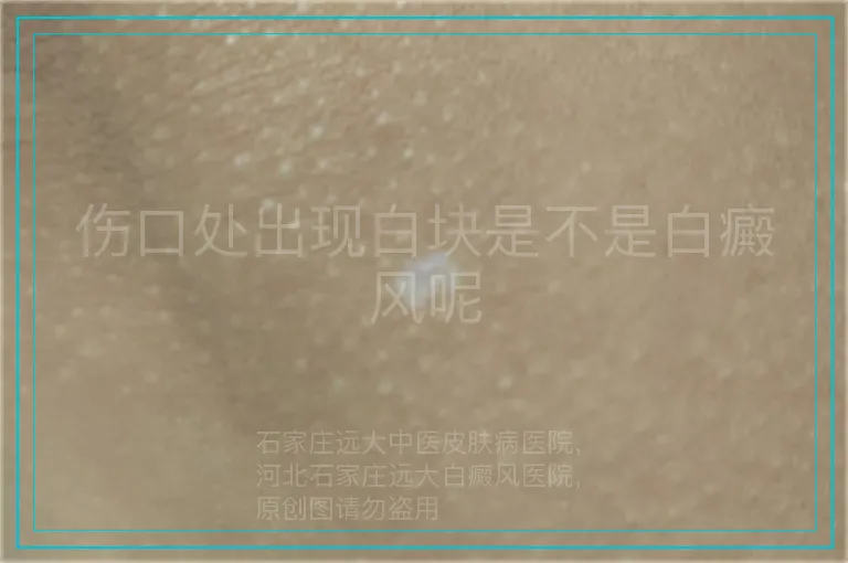 伤口处出现白块是不是白癜风呢