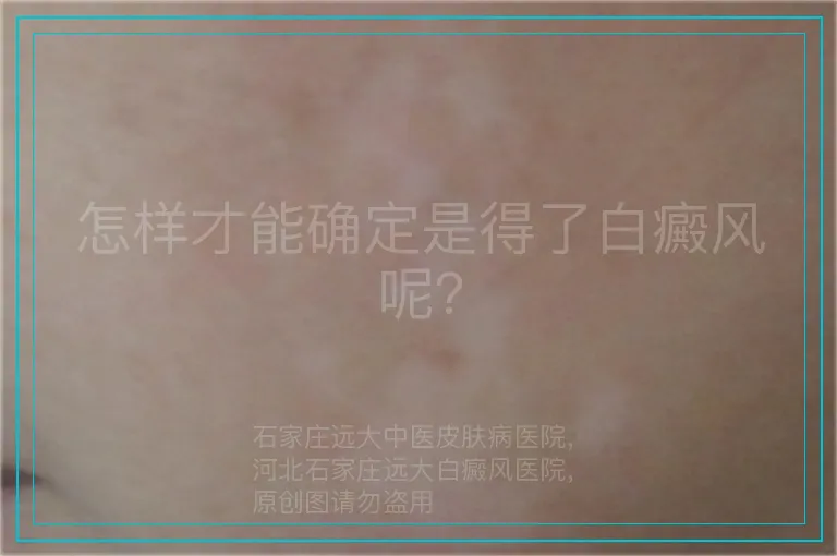 怎样才能确定是得了白癜风呢？