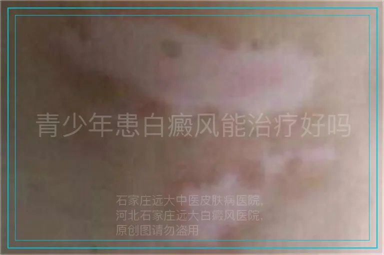 青少年患白癜风能治疗好吗