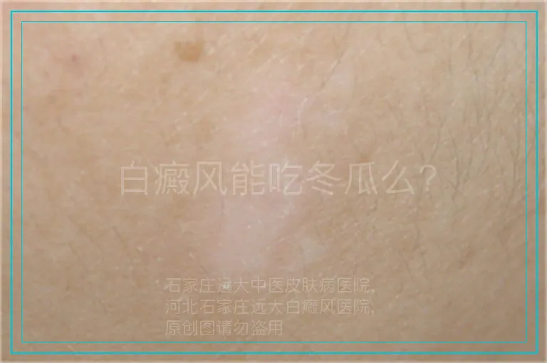 白癜风能吃冬瓜么?
