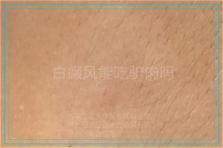 白癜风能吃驴肉吗