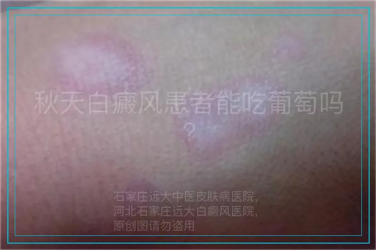 秋天白癜风患者能吃葡萄吗?