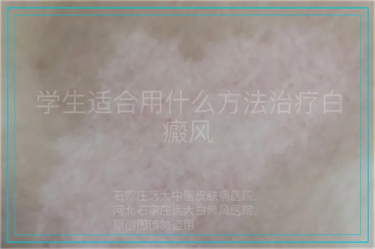 学生适合用什么方法治疗白癜风