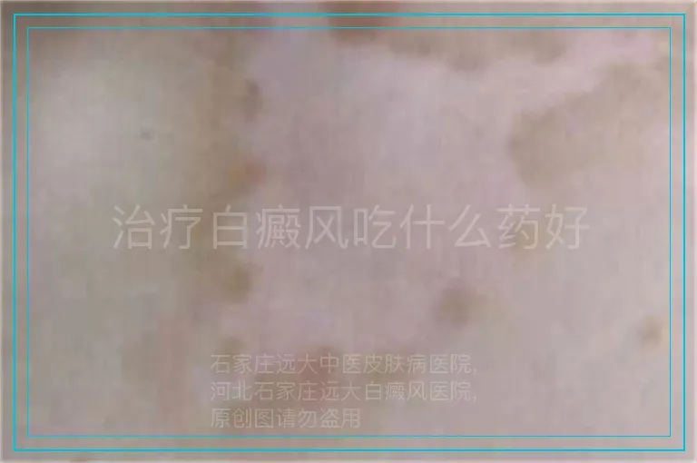 治疗白癜风吃什么药好
