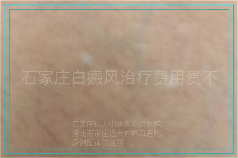 石家庄白癜风治疗费用贵不