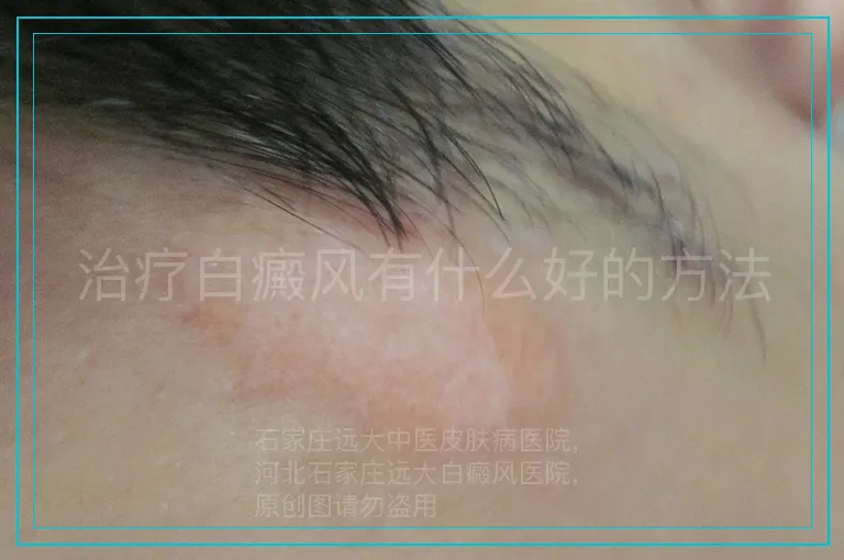 治疗白癜风有什么好的方法