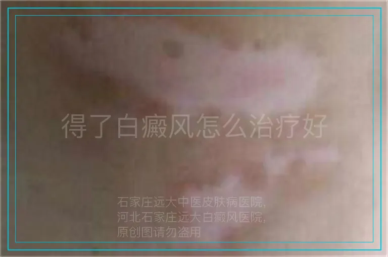 得了白癜风怎么治疗好