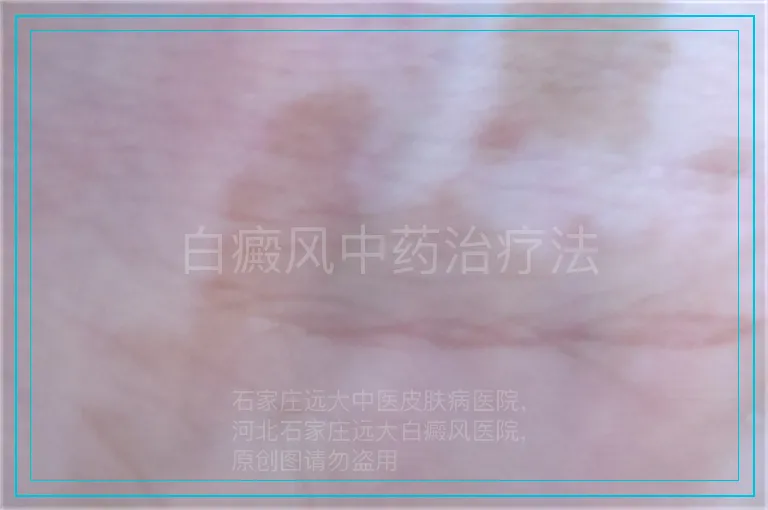 白癜风中药治疗法