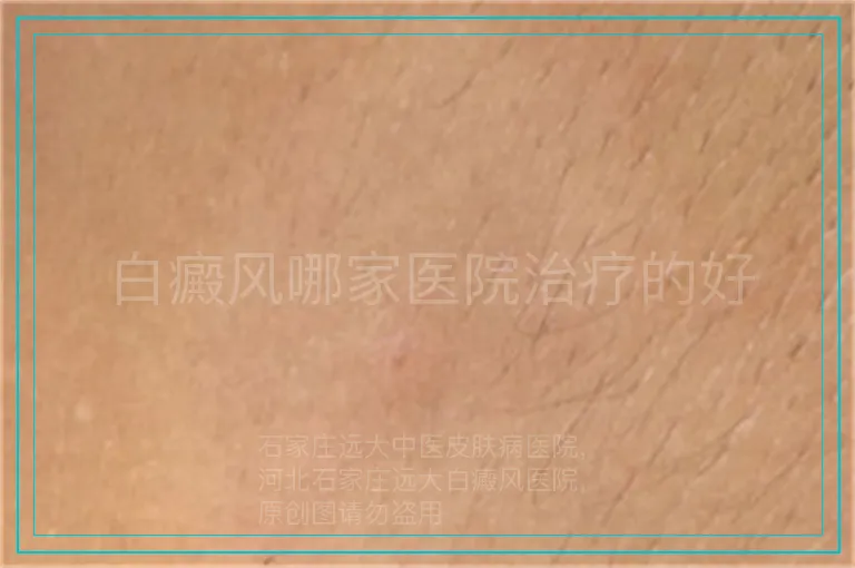白癜风哪家医院治疗的好