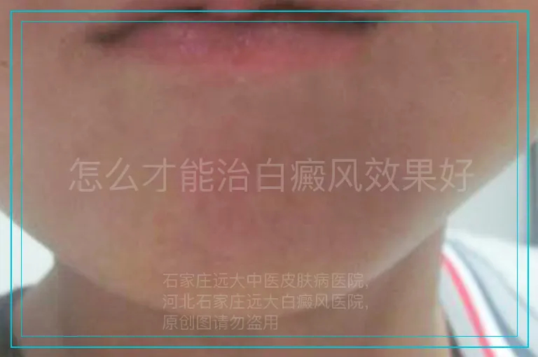 怎么才能治白癜风效果好