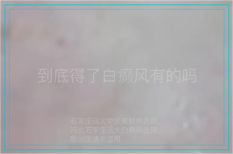 到底得了白癫风有的吗