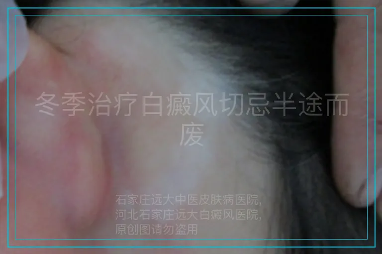 冬季治疗白癜风切忌半途而废