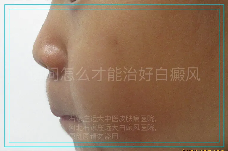 请问怎么才能治好白癜风