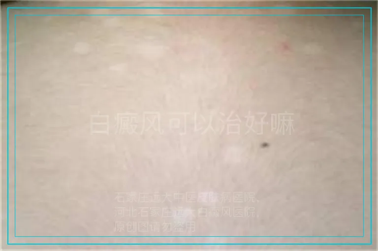 白癜风可以治好嘛