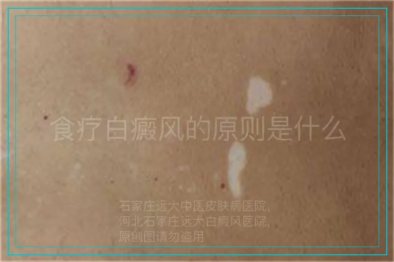 食疗白癜风的原则是什么