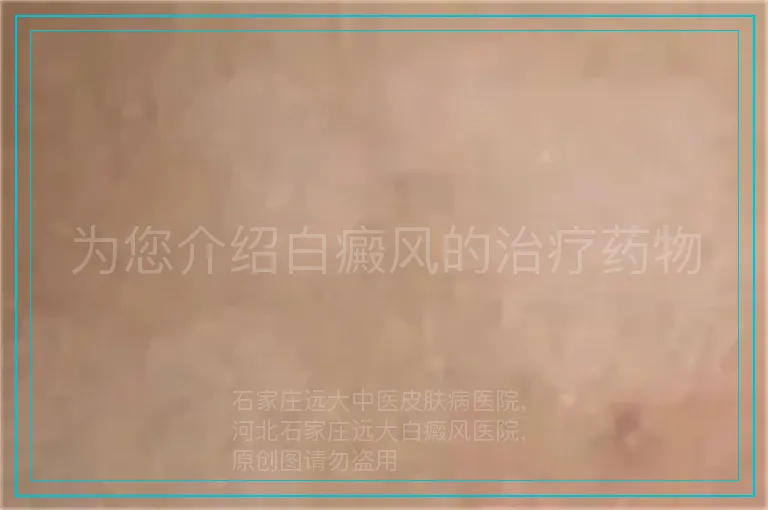 为您介绍白癜风的治疗药物