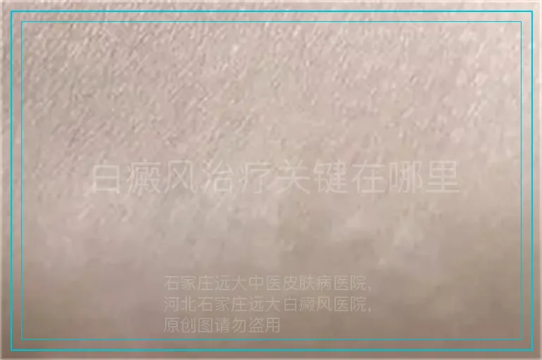 白癜风治疗关键在哪里