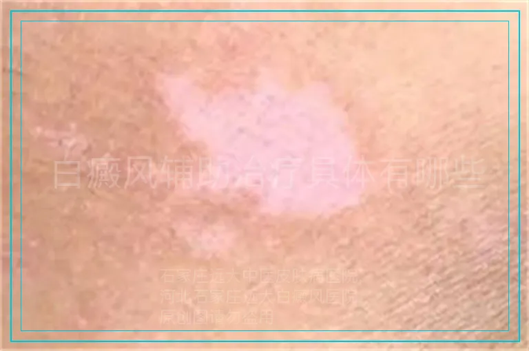 白癜风辅助治疗具体有哪些