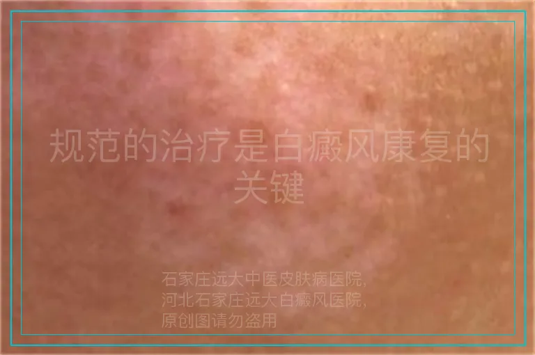 规范的治疗是白癜风康复的关键