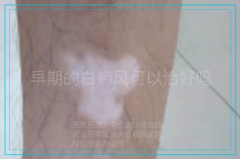 早期的白癜风可以治好吗